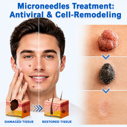 ✨【30%OFF only today】Hiskin ® 2-in-1 Microneedle & Hydrocolloid Patch🍀 | Removes raised moles, acne, flat warts, and skin tags | Helps improve wrinkles, scars, and blemishes | Invisible patches for face and body
