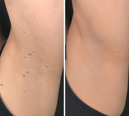 ✨【30%OFF only today】Hiskin ® 2-in-1 Microneedle & Hydrocolloid Patch🍀 | Removes raised moles, acne, flat warts, and skin tags | Helps improve wrinkles, scars, and blemishes | Invisible patches for face and body