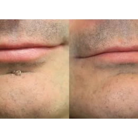 ✨【30%OFF only today】Hiskin ® 2-in-1 Microneedle & Hydrocolloid Patch🍀 | Removes raised moles, acne, flat warts, and skin tags | Helps improve wrinkles, scars, and blemishes | Invisible patches for face and body