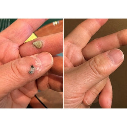 ✨【30%OFF only today】Hiskin ® 2-in-1 Microneedle & Hydrocolloid Patch🍀 | Removes raised moles, acne, flat warts, and skin tags | Helps improve wrinkles, scars, and blemishes | Invisible patches for face and body