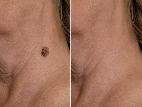 ✨【30%OFF only today】Hiskin ® 2-in-1 Microneedle & Hydrocolloid Patch🍀 | Removes raised moles, acne, flat warts, and skin tags | Helps improve wrinkles, scars, and blemishes | Invisible patches for face and body