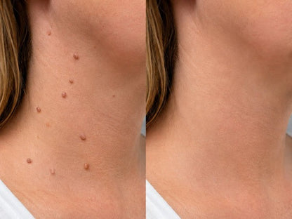 ✨【30%OFF only today】Hiskin ® 2-in-1 Microneedle & Hydrocolloid Patch🍀 | Removes raised moles, acne, flat warts, and skin tags | Helps improve wrinkles, scars, and blemishes | Invisible patches for face and body