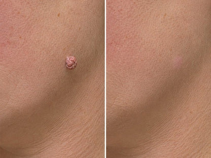 ✨【30%OFF only today】Hiskin ® 2-in-1 Microneedle & Hydrocolloid Patch🍀 | Removes raised moles, acne, flat warts, and skin tags | Helps improve wrinkles, scars, and blemishes | Invisible patches for face and body
